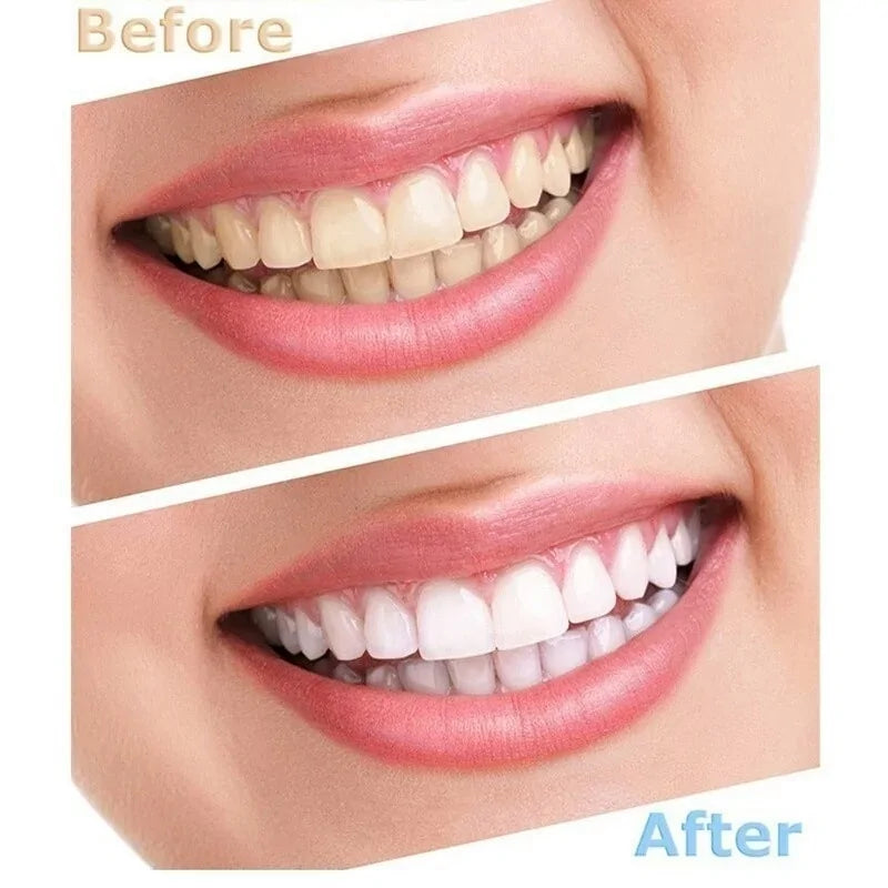 LED Teeth Whitening Kit - Professional Grade